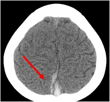 Clinical Characteristics and Outcomes of Pediatric Cerebral Venous Sinus Thrombosis: An Analysis of 30 Cases in China